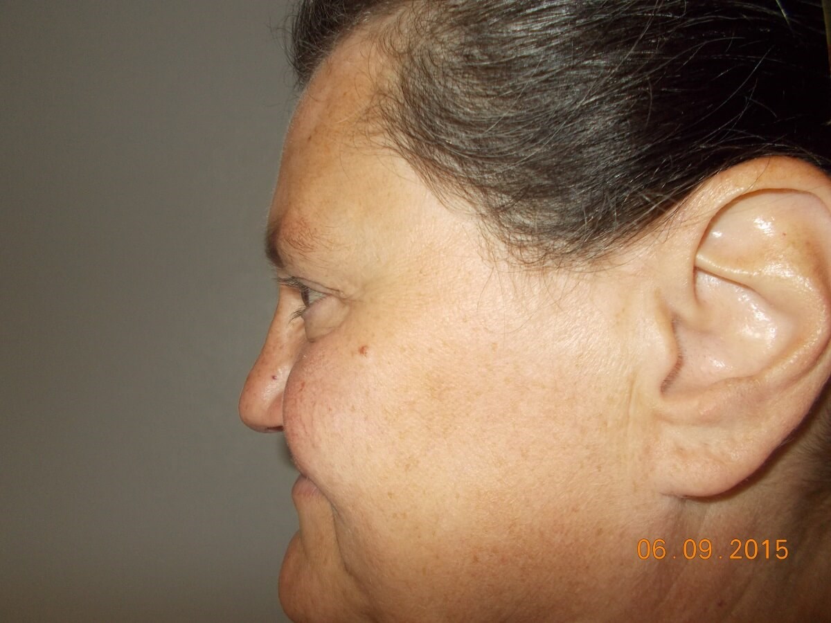 Side View Before