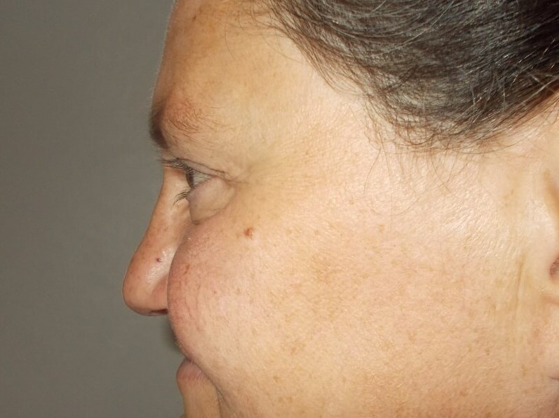 Side View Before