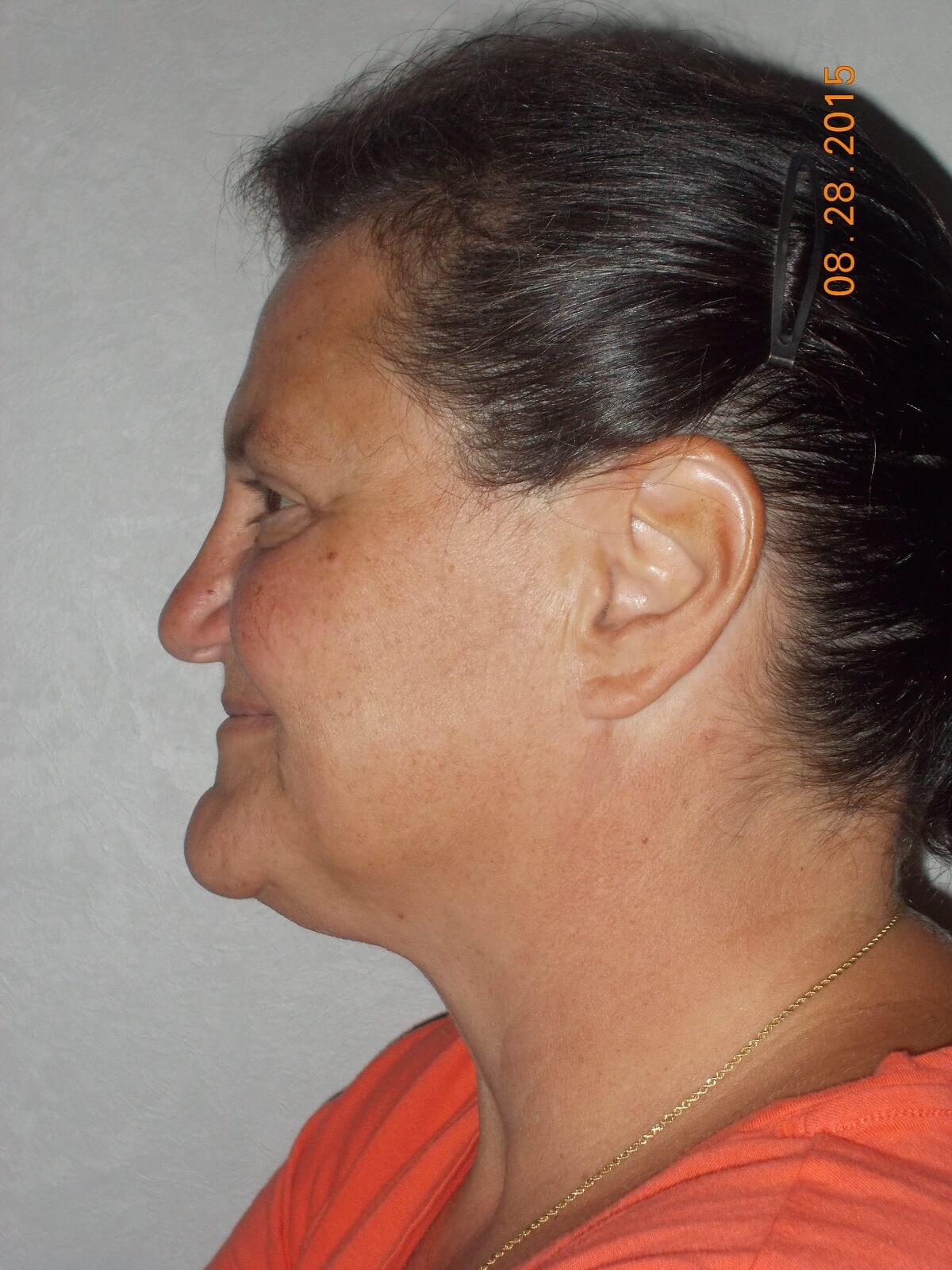 Side View After