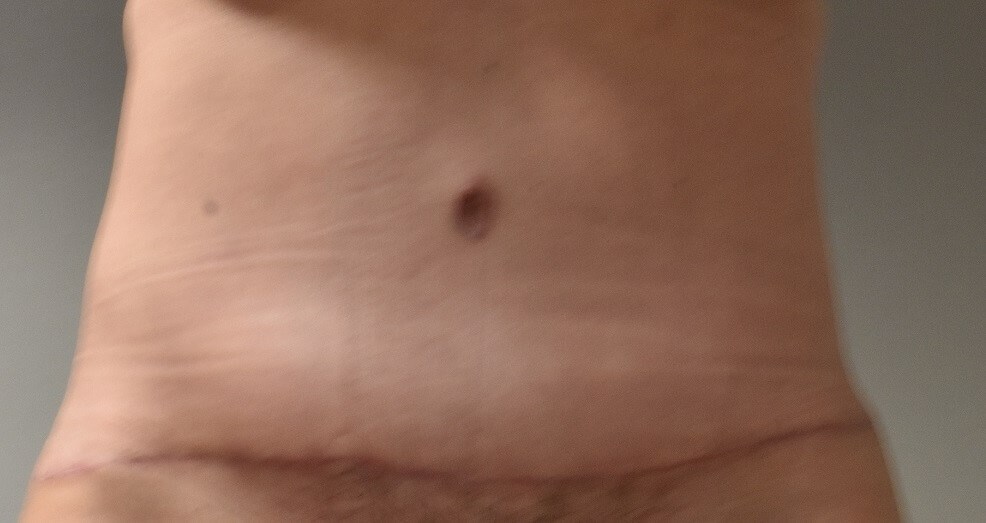 Front View After
