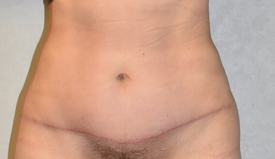 Front View After