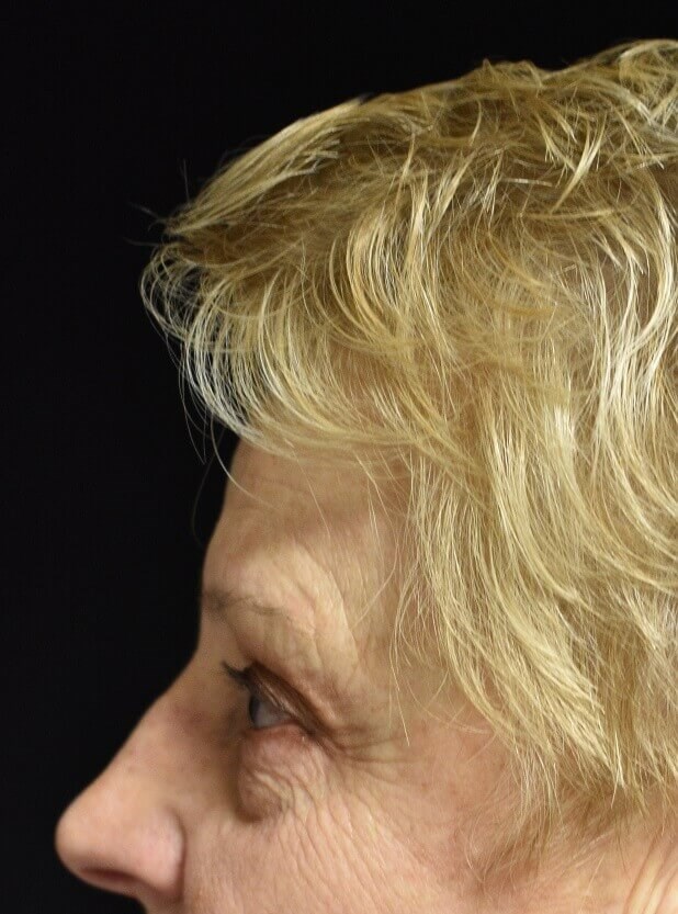 Side View After