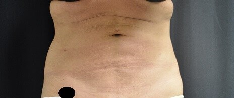 Front View After