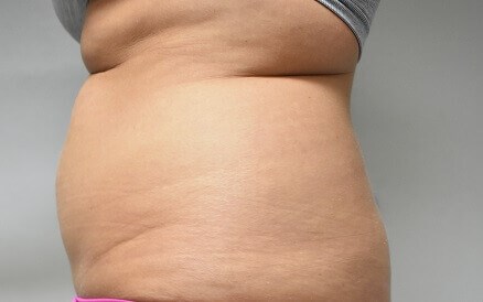 Side View Before