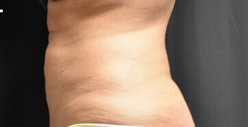 Side View After