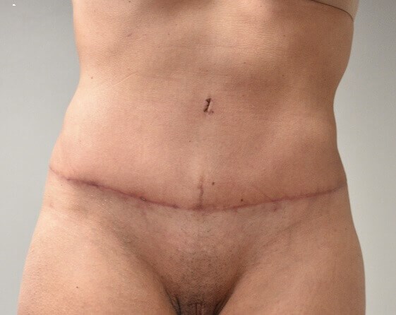 Front View After