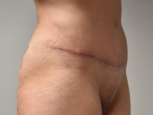 3/4 View After