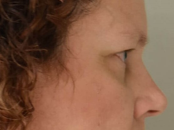 Side View Before