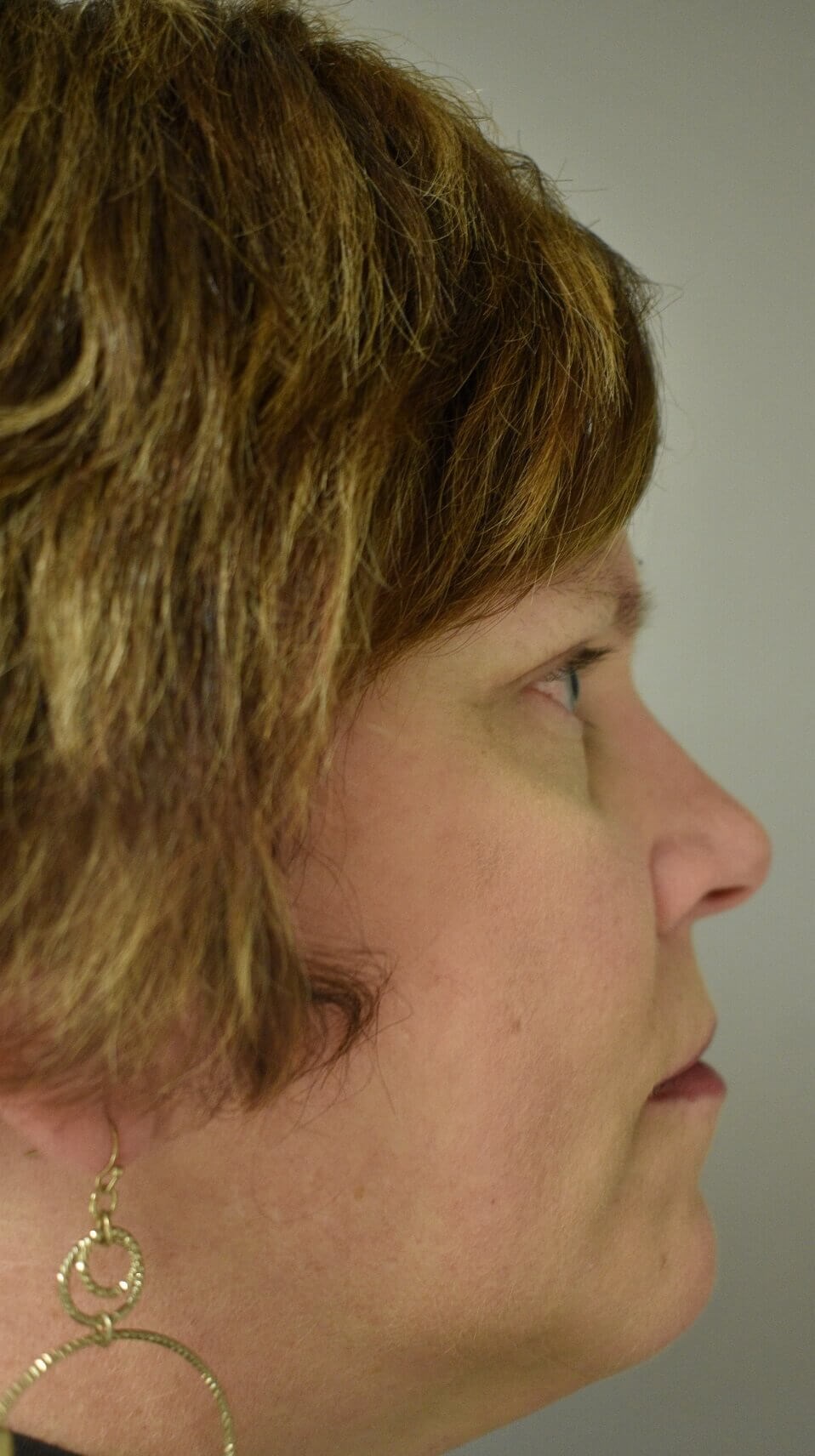 Side View After