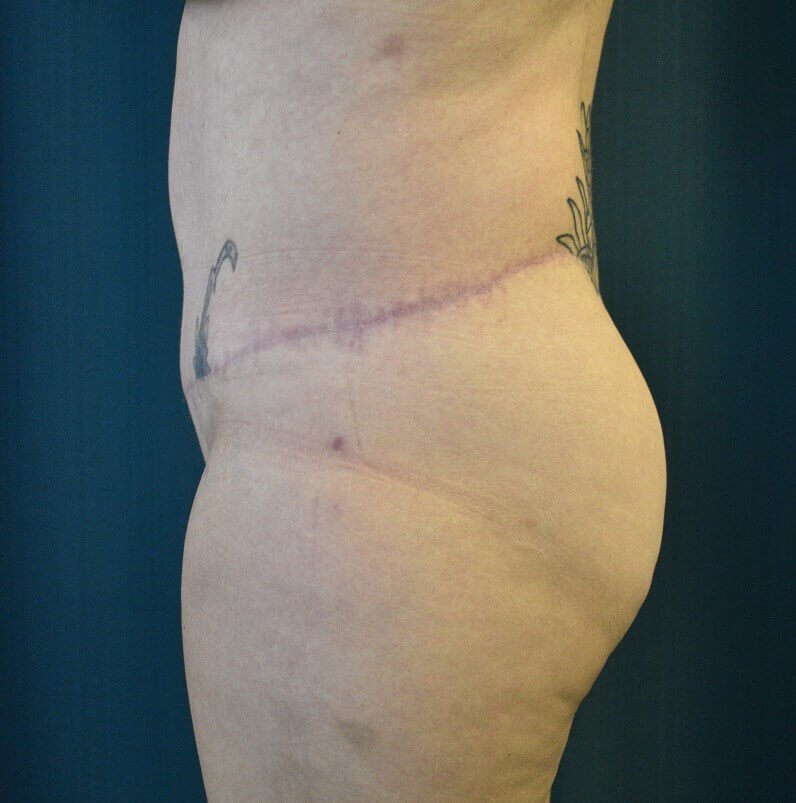 Side View After