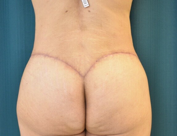 Back View After