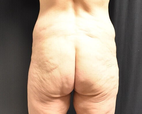 Back View Before