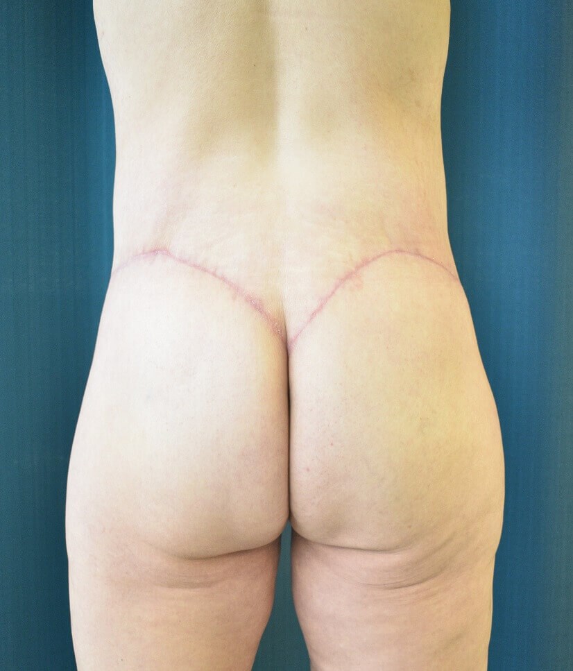 Back View After
