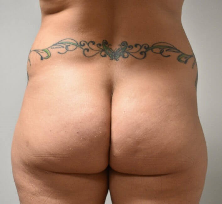 Back View Before