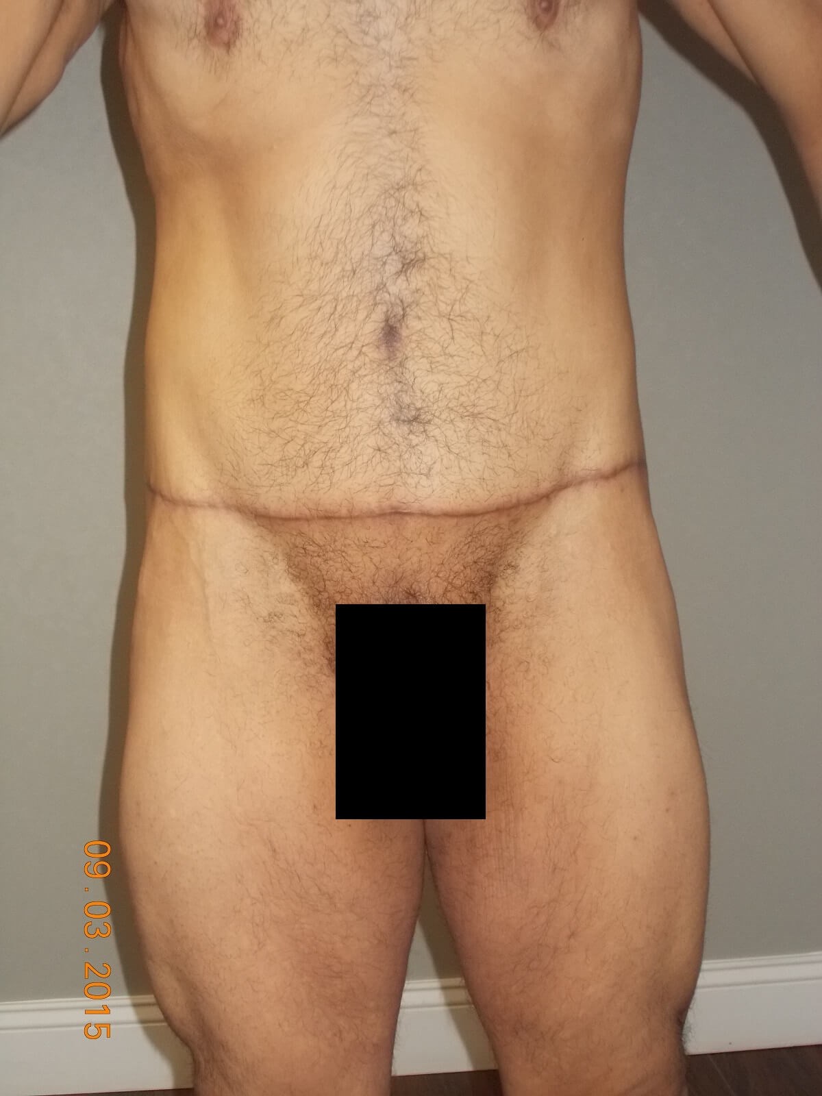 Front View After