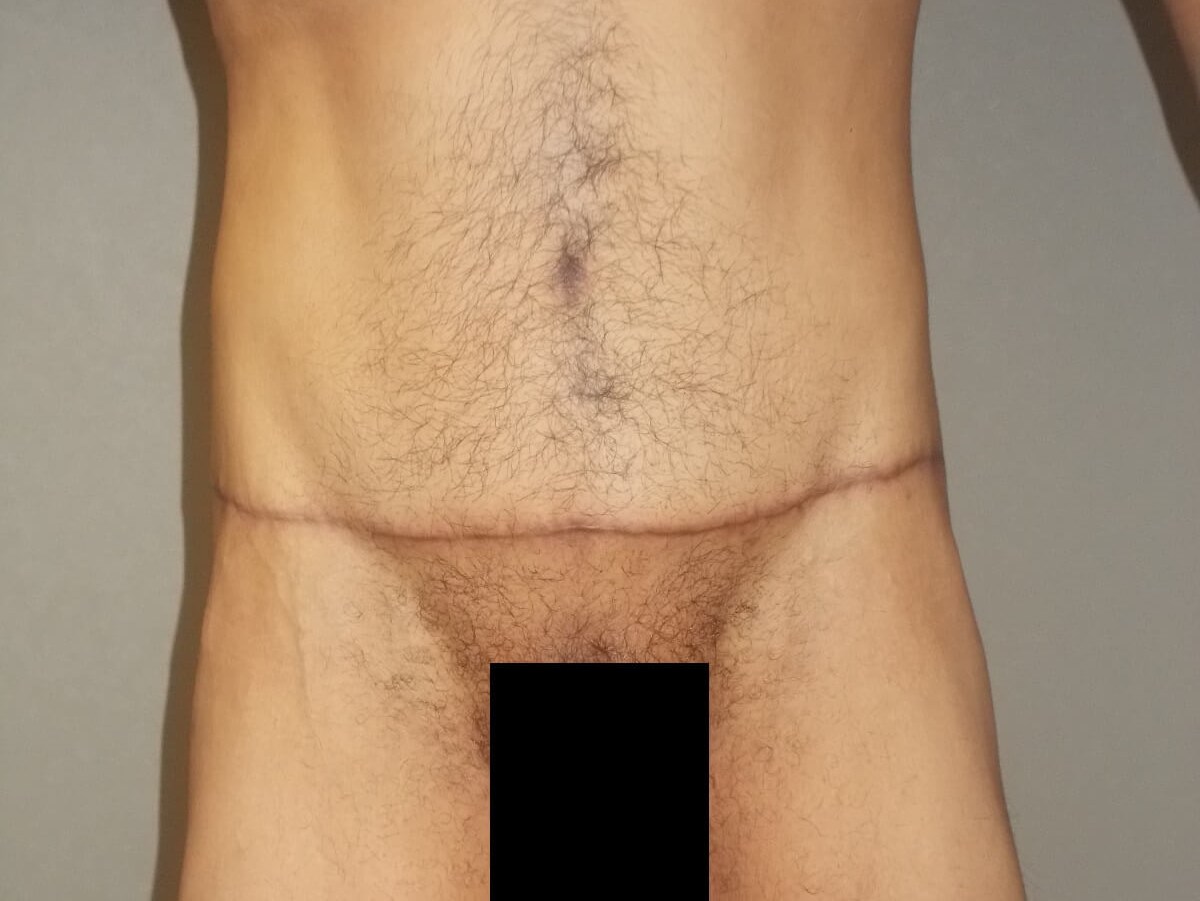 Front View After