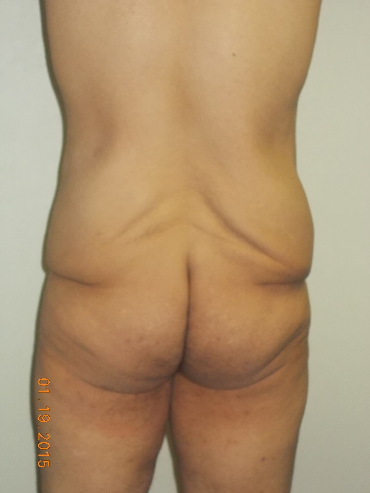 Back View Before