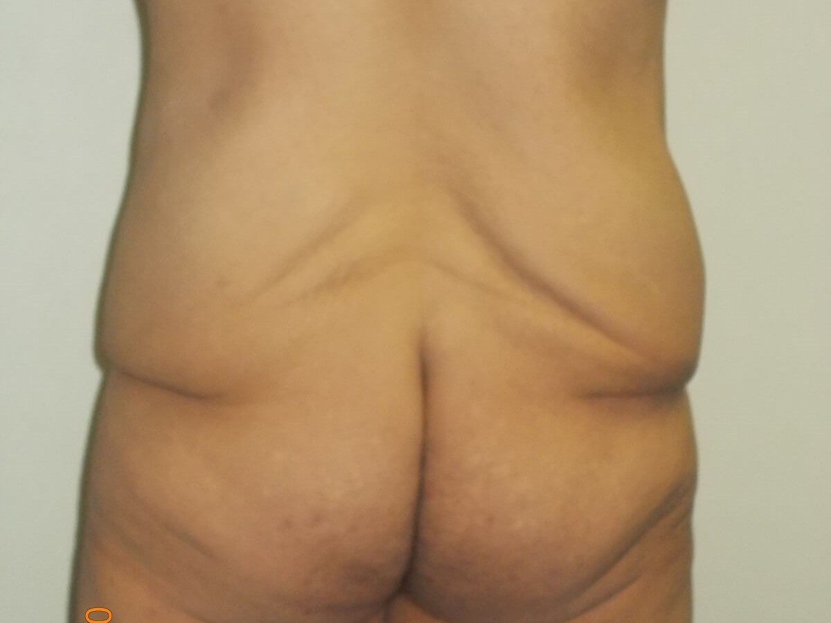 Back View Before