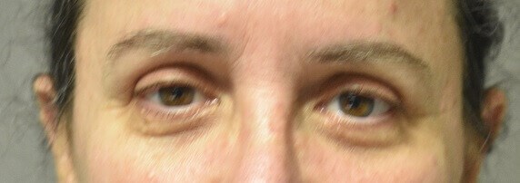 Front View After