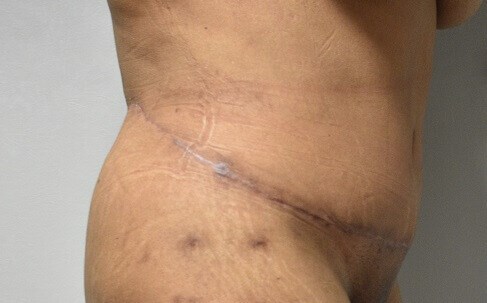 Side View After