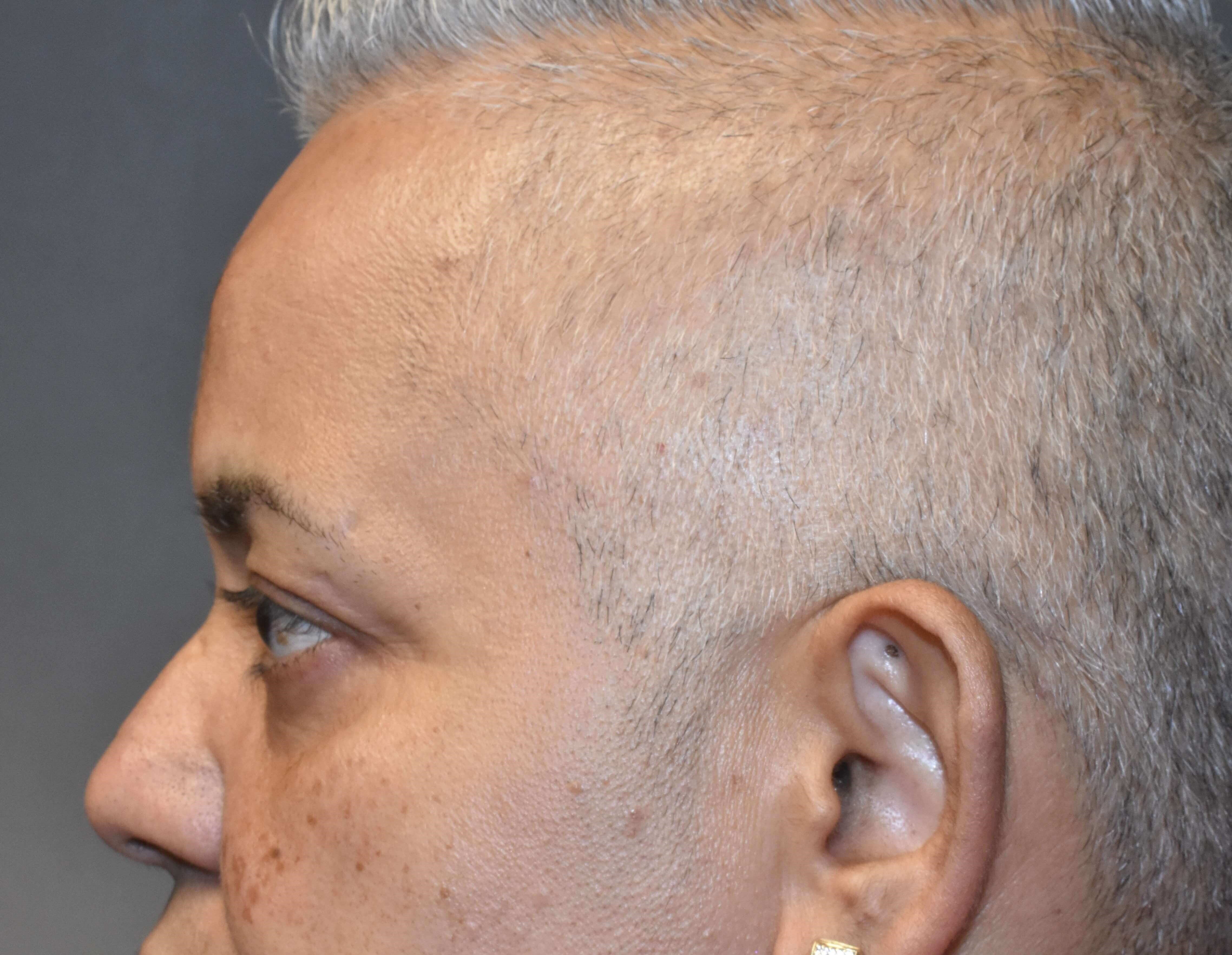 Side View Before