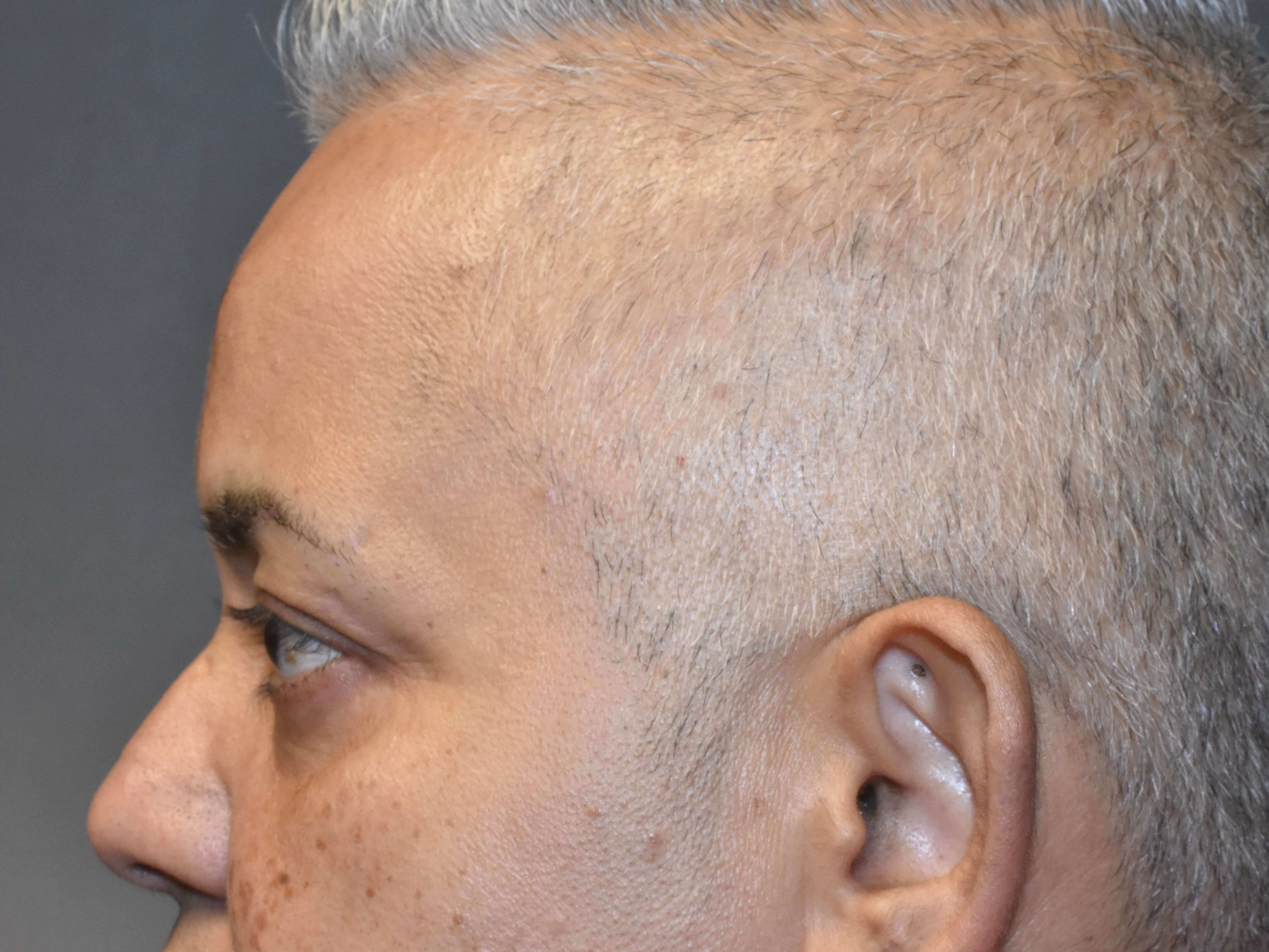 Side View Before