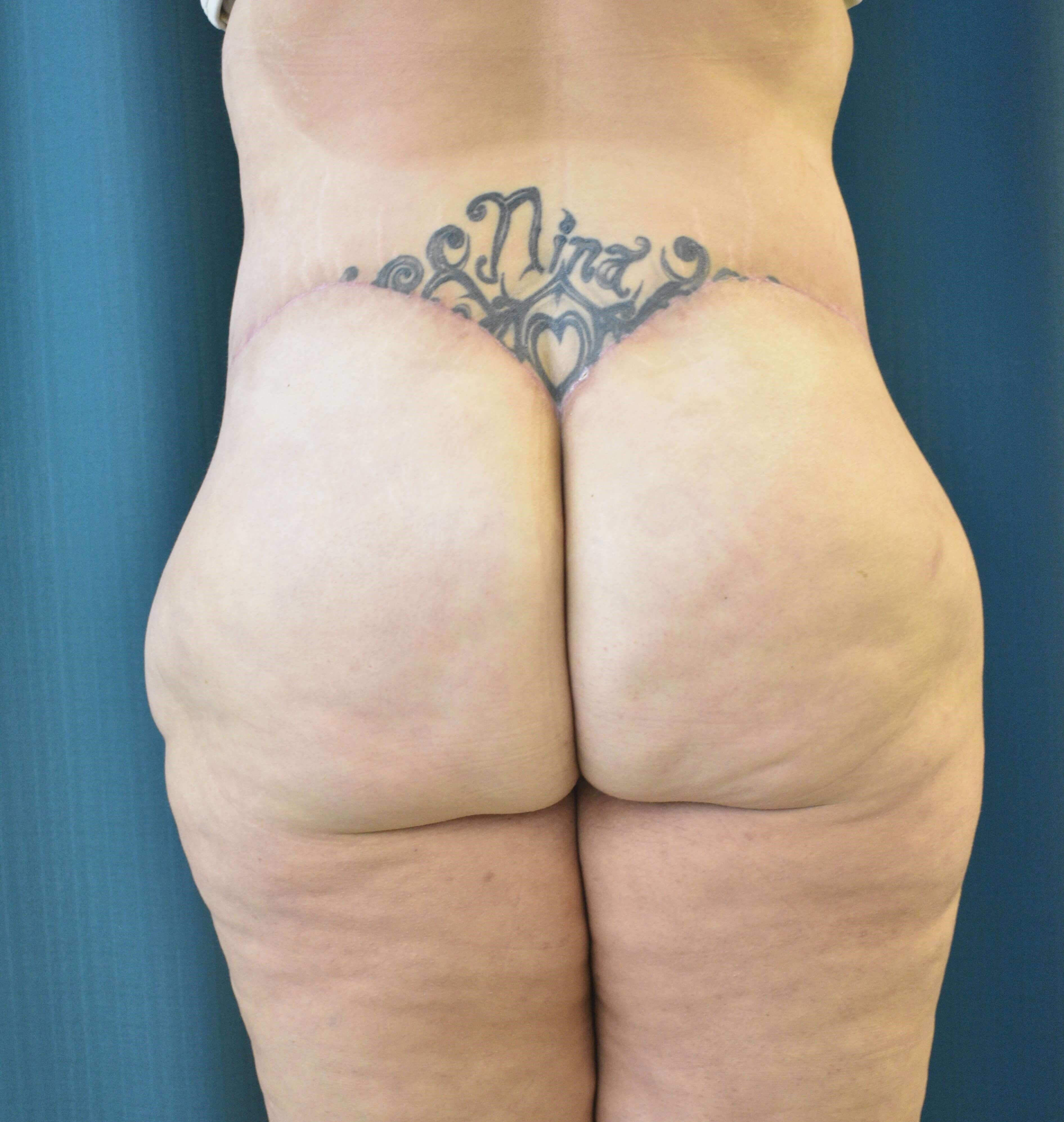 Back View After