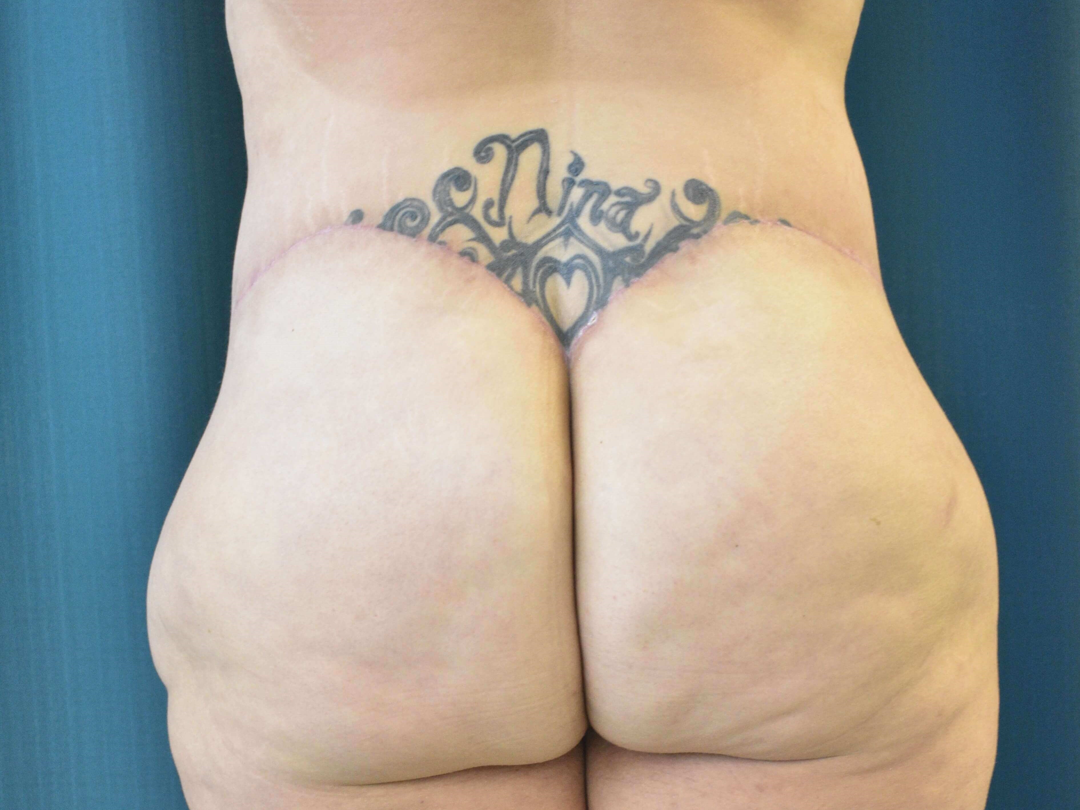 Back View After