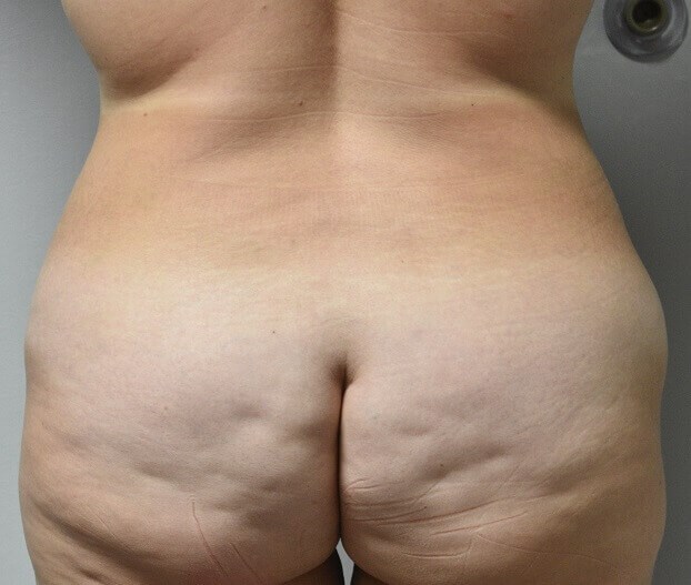 Back View Before
