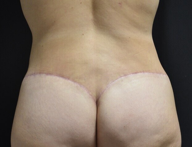 Back View After