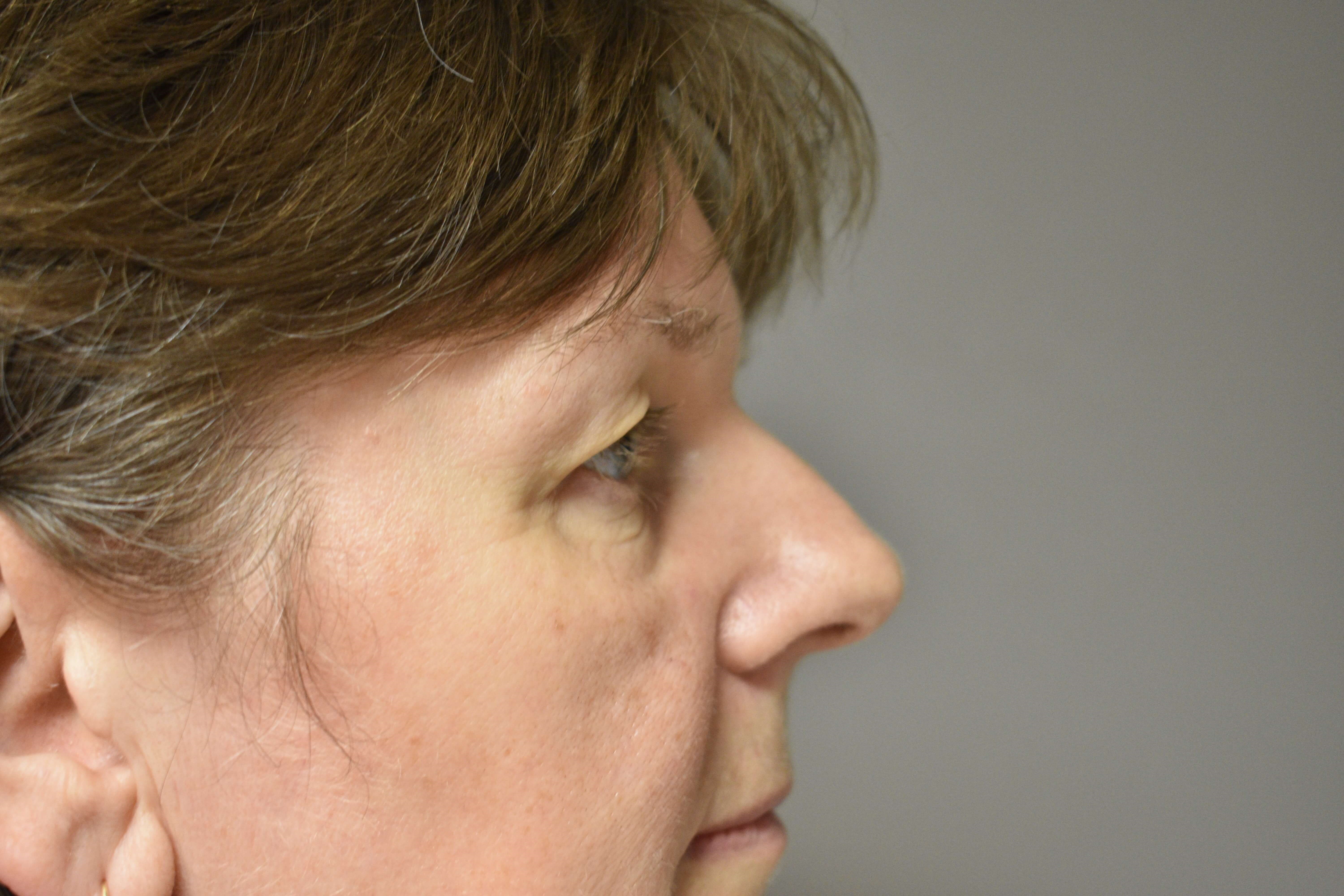 Side View Before