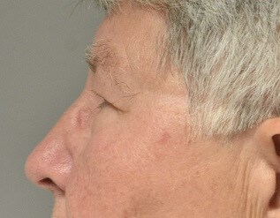 Left Side Before