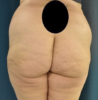 Back View Before