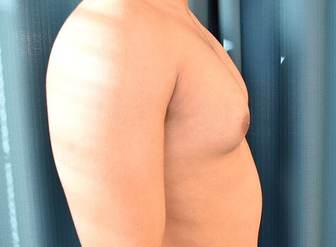 Side View Before