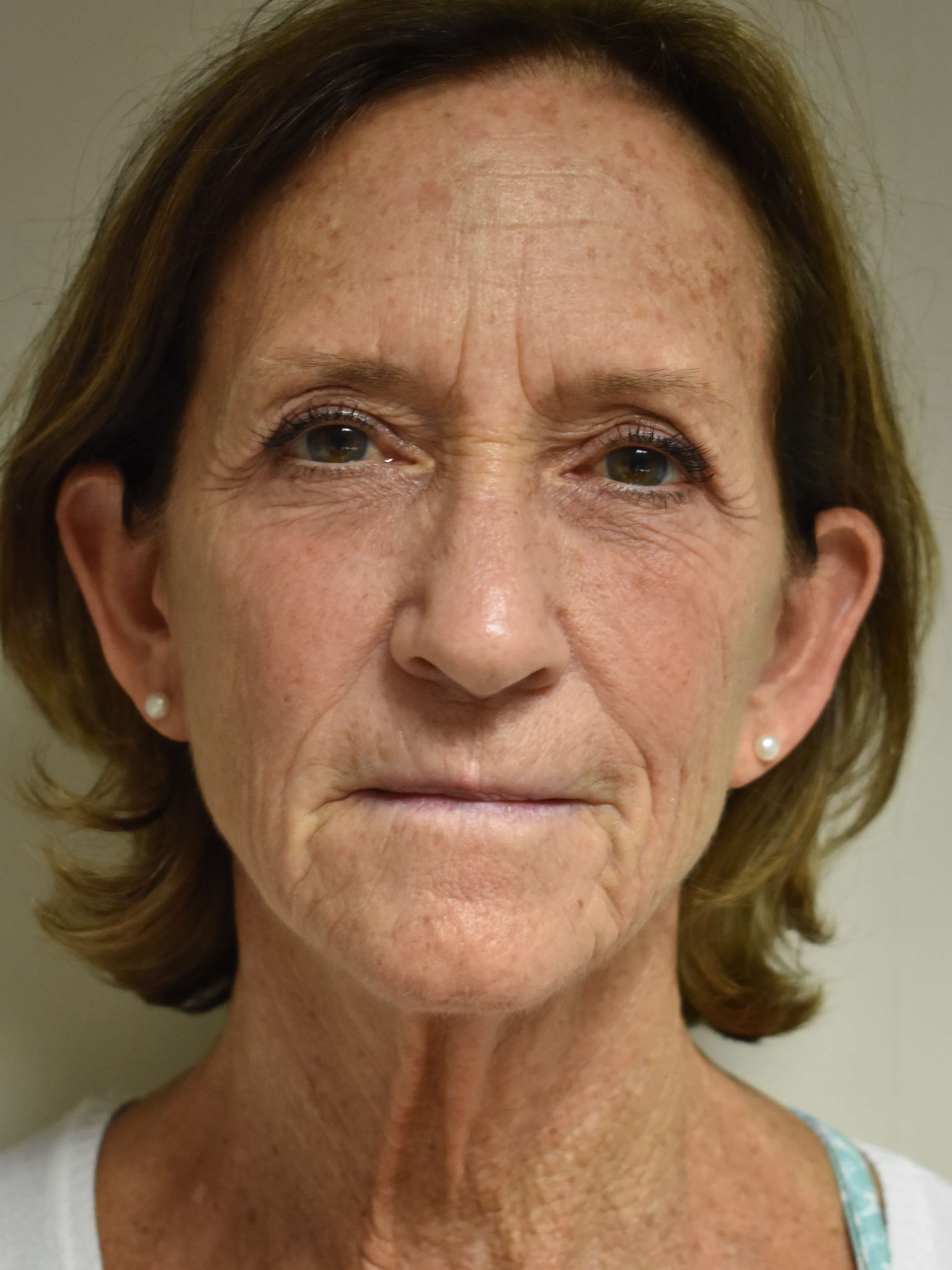 Face Lift  and Eyelid Surgery Before Face lift and Eye Surg.