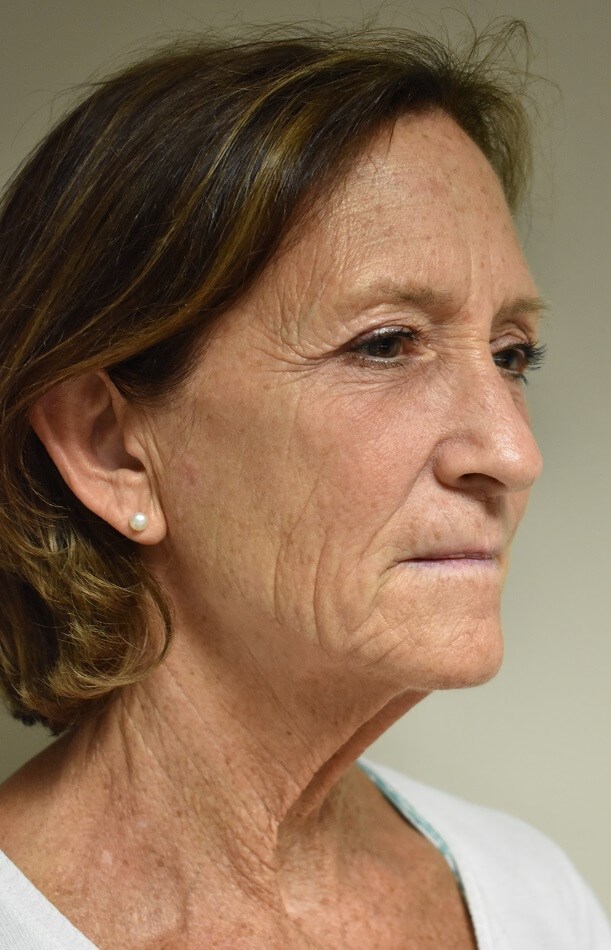 Face lift [face,neck,eyelids] Before Face lift