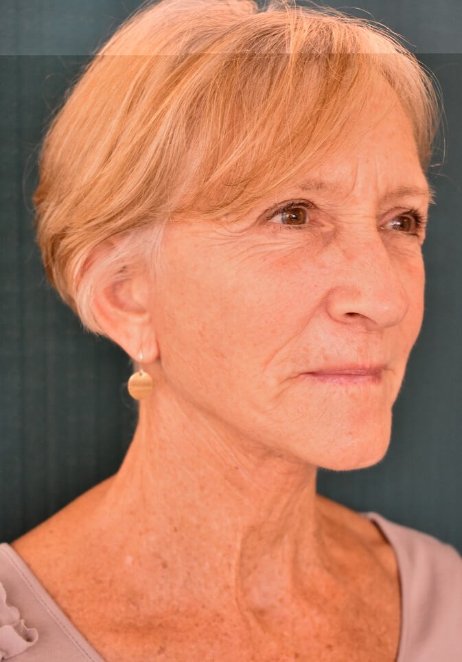 Face lift [face,neck,eyelids] After Face lift