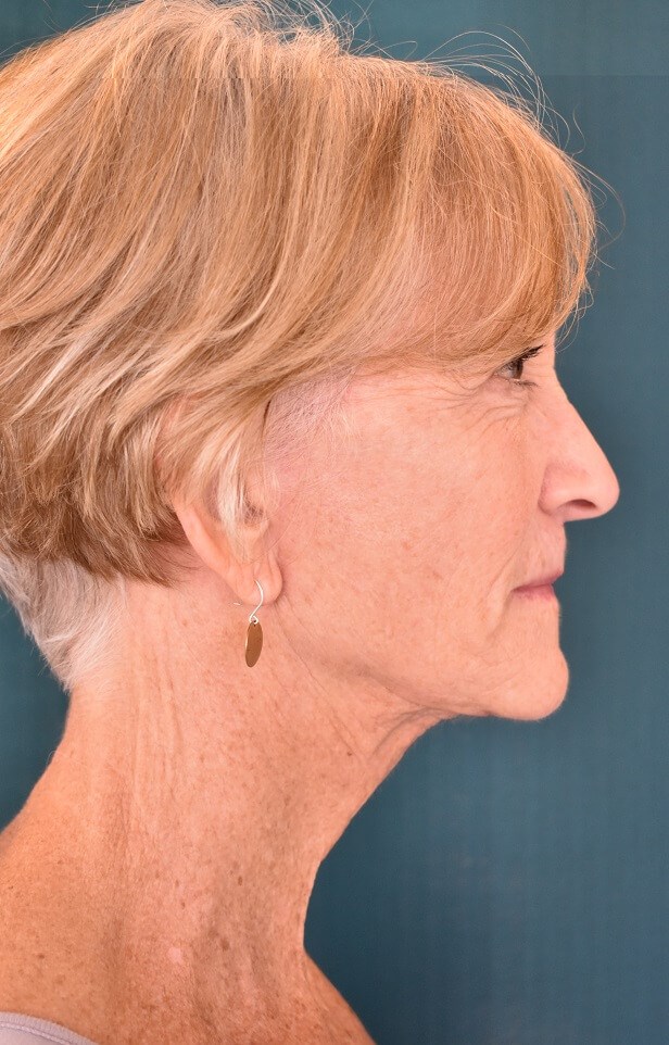 Side View After Face lift