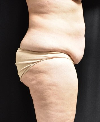 Before & After Lateral view Before Abdominoplasty
