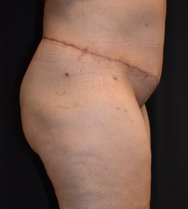 Before & After Lateral view After Abdominoplasty