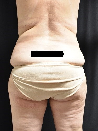 Before & After Posterior view Before Abdominoplasty