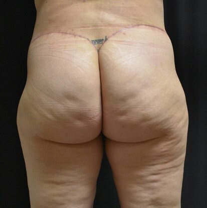 Before & After Posterior view After Abdominoplasty