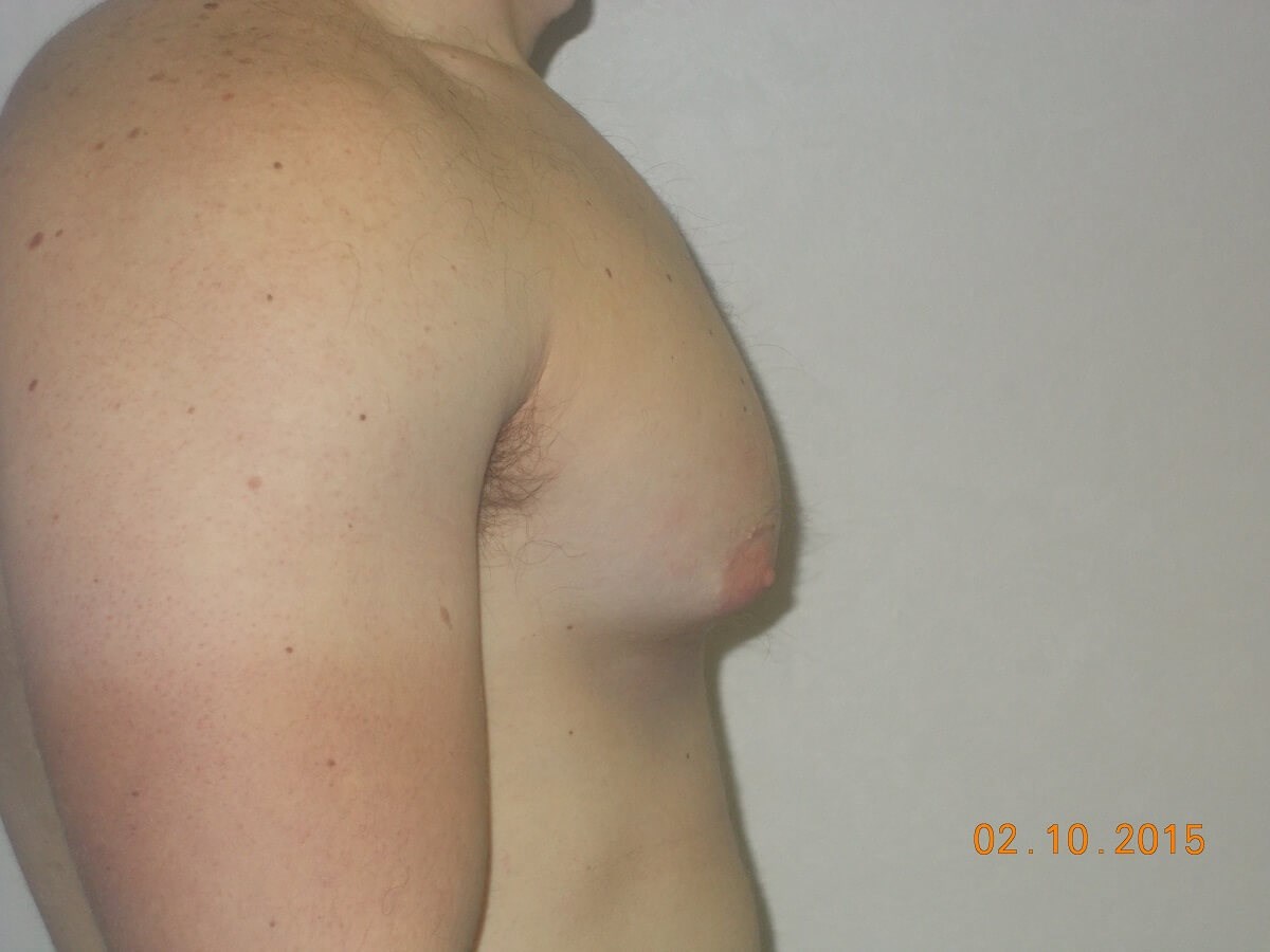 Side View Before