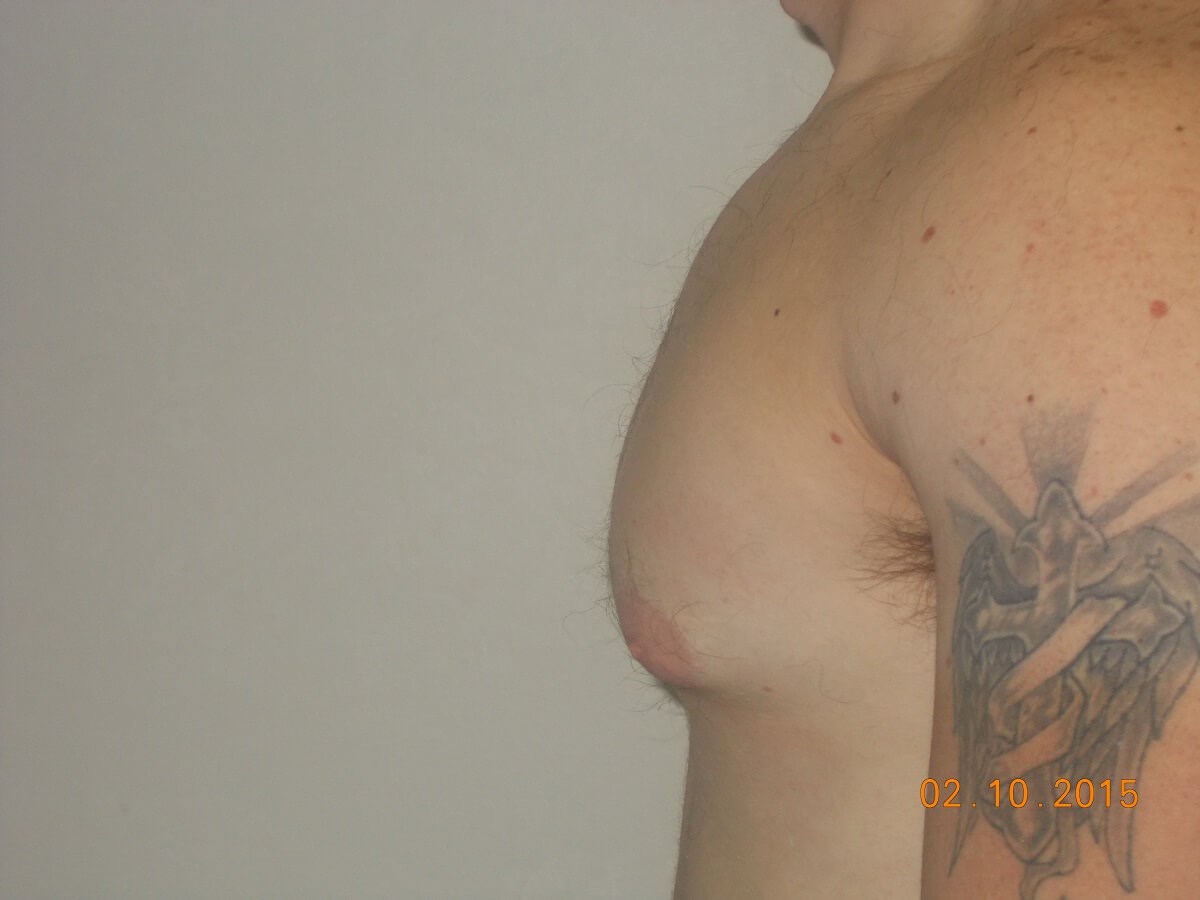 Side View Before