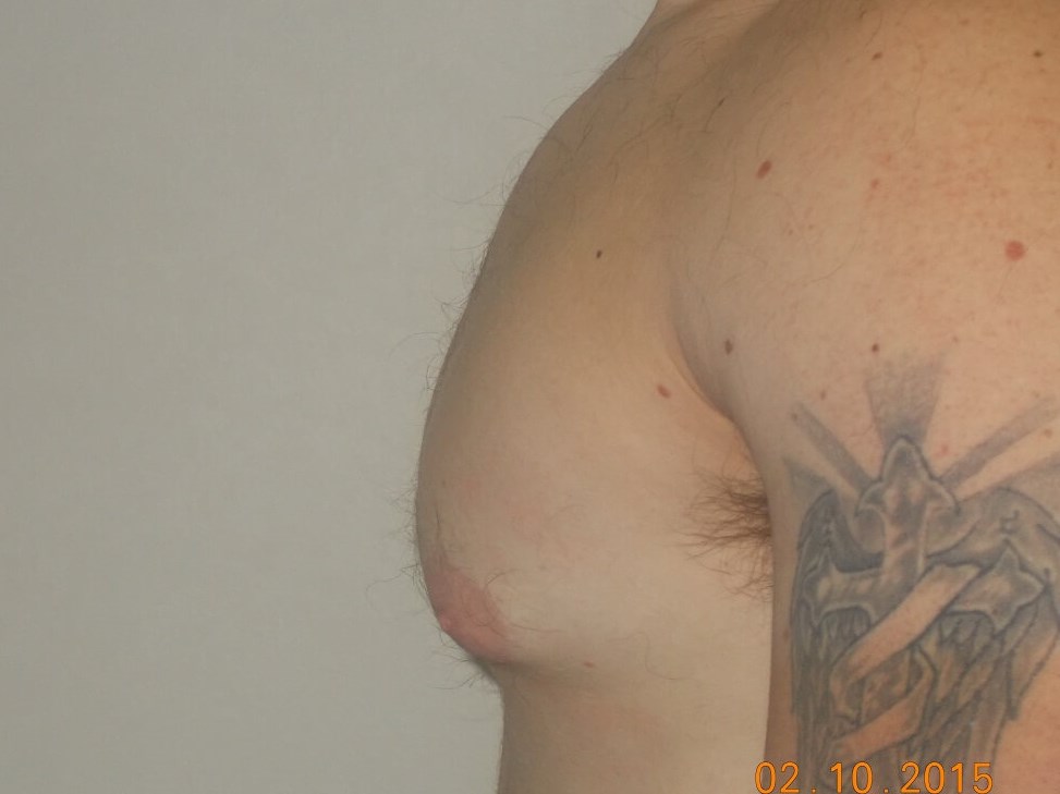 Side View Before