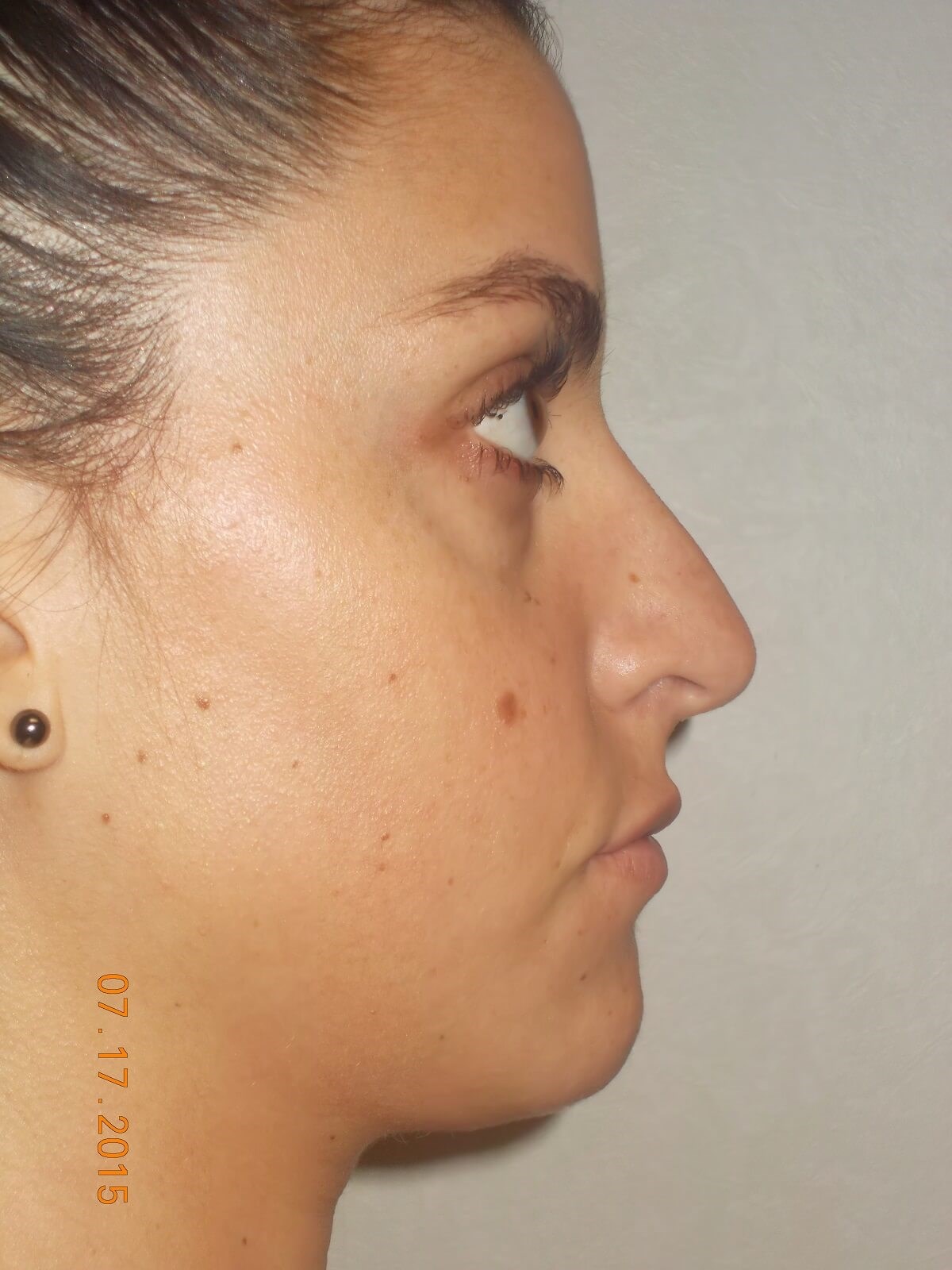 Side View Before