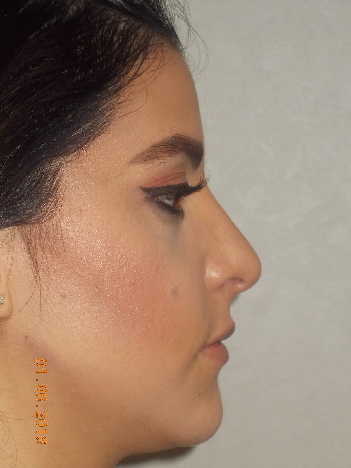Side View After