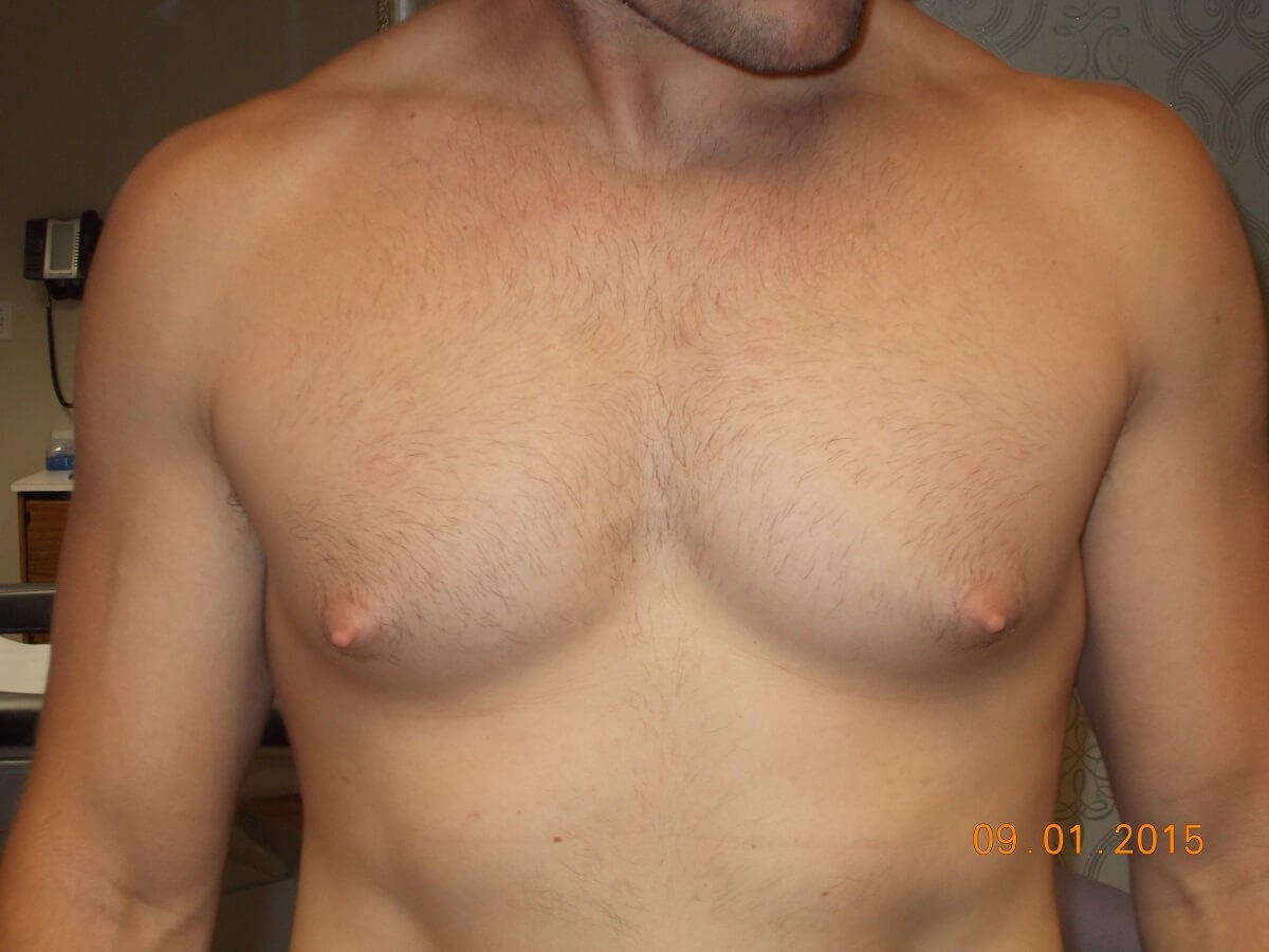 Front View Before