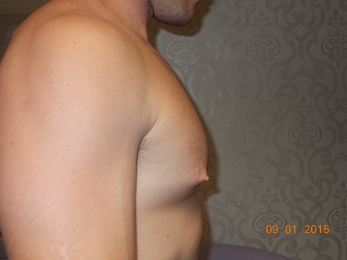 Side View Before