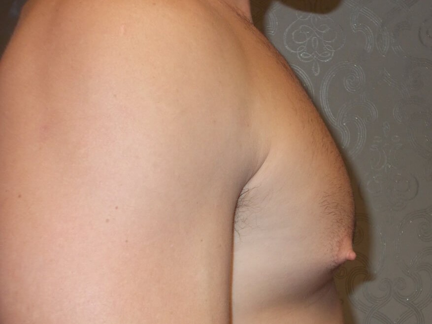 Side View Before